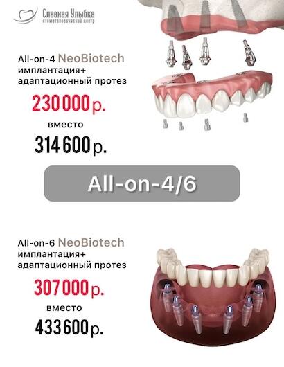 Имплантация + протезирование